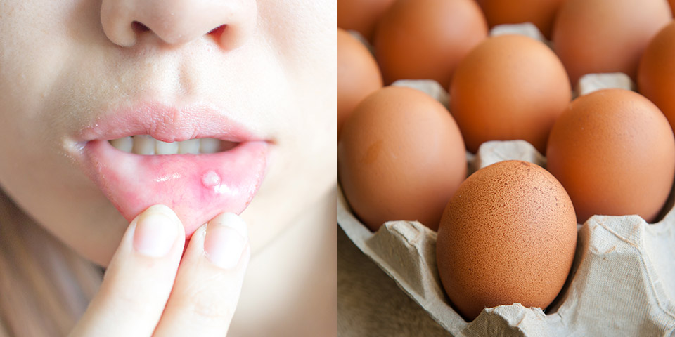 卵のリジン摂取で口唇ヘルペスを抑え込む！